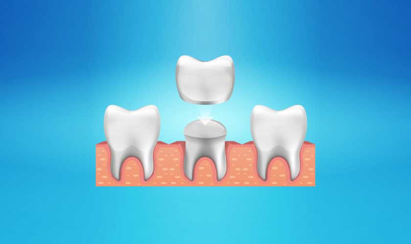 Dental Crown