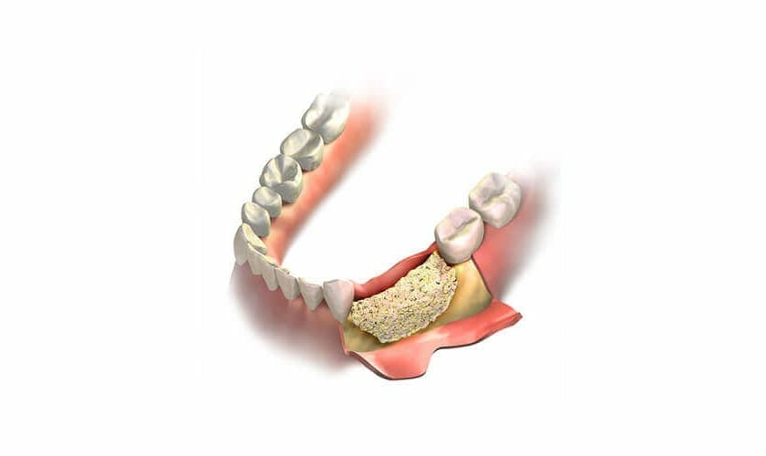 Bone Grafting