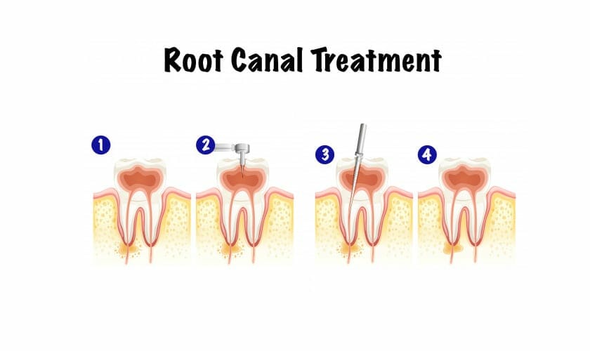 Root Canal Treatment