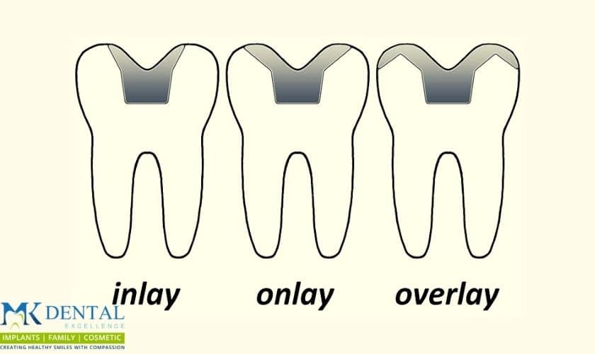 Dental Inlays & Dental Onlays