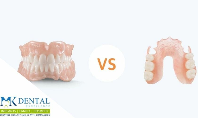 Full vs Partial Dentures