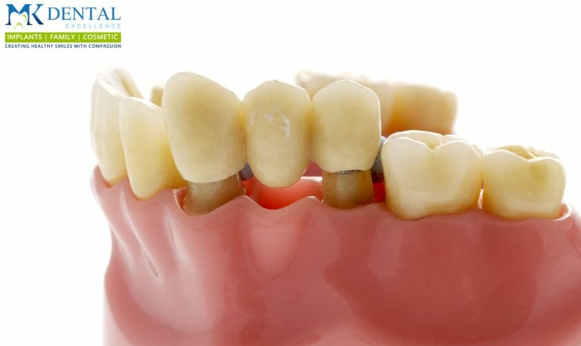 dental bridges