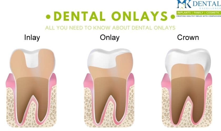 Dental Onlays Cincinnati