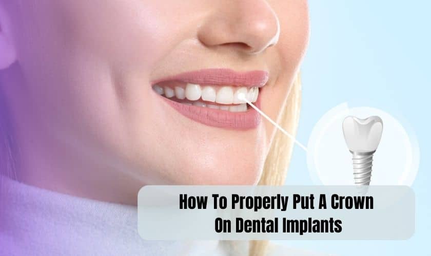 How To Properly Put A Crown On Dental Implants