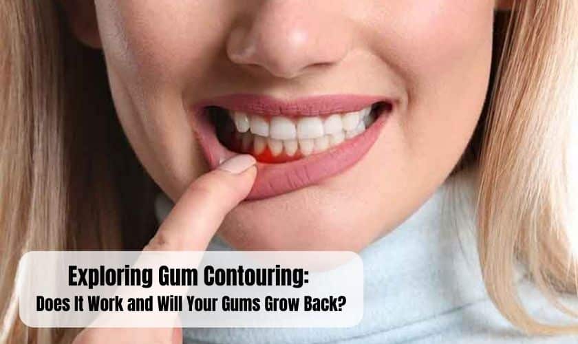 Exploring Gum Contouring