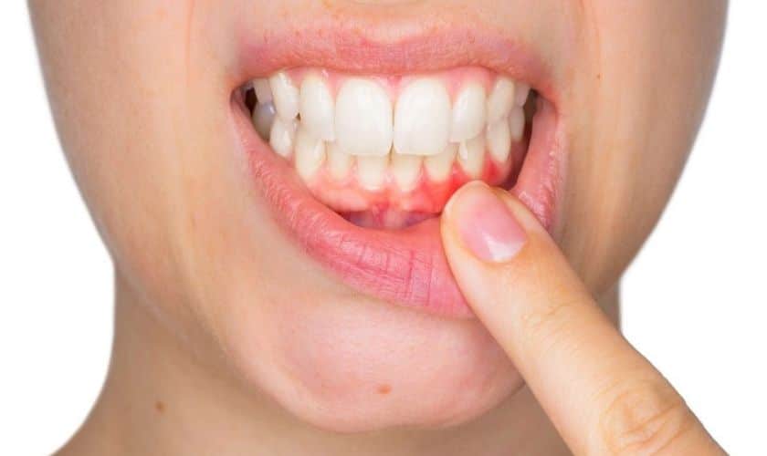 mk dental excellence dentist cincinnati professional treatments for regrowing receded gums