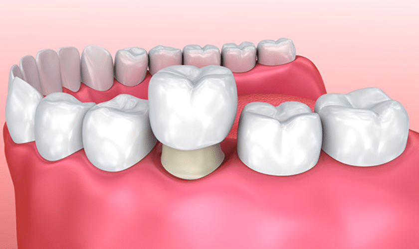 Porcelain Dental Crowns