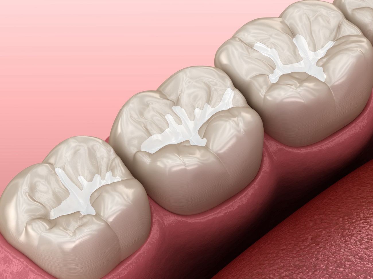 composite fillings explained by mk dental excellence dentist cincinnati