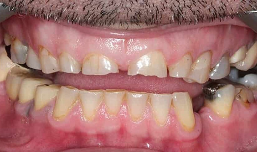 mk dental excellence dentist cincinnati before porcelain veneers