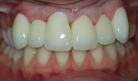 mk dental excellence dentist cincinnati after invisalign treatment