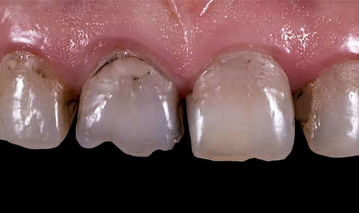 mk dental excellence dentist cincinnati before porcelain veneers