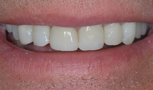 mk dental excellence dentist cincinnati after dental implants