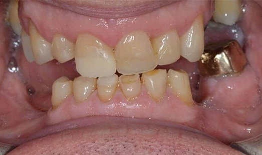mk dental excellence dentist cincinnati before dental implants