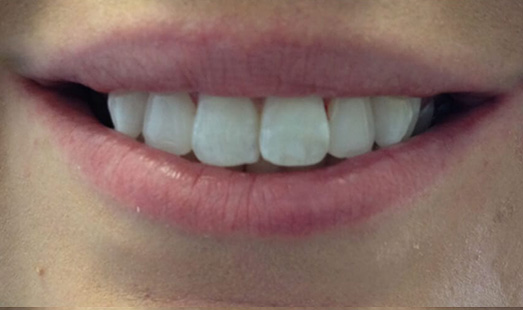 mk dental excellence dentist cincinnati after teeth whitening