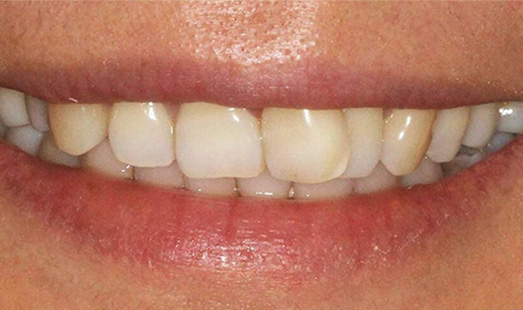 mk dental excellence dentist cincinnati before invisalign treatment