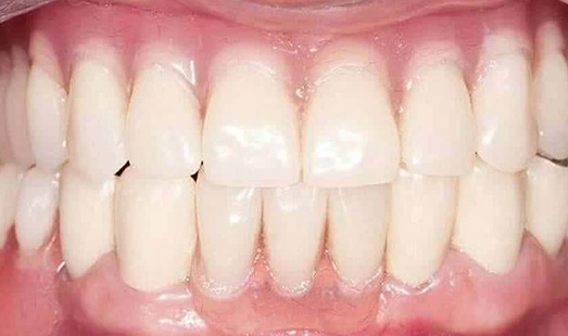 mk dental excellence dentist cincinnati after dental implants
