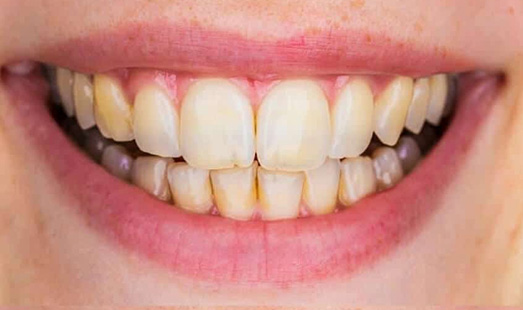 mk dental excellence dentist cincinnati before teeth whitening