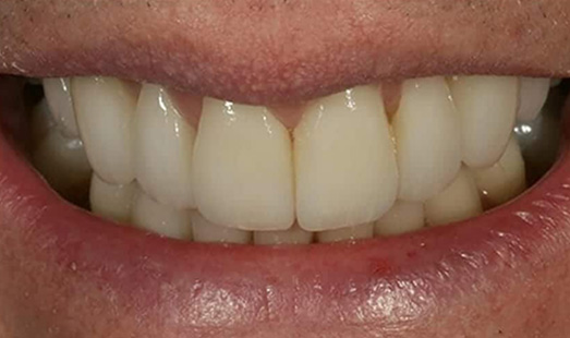 mk dental excellence dentist cincinnati after kor teeth whitening