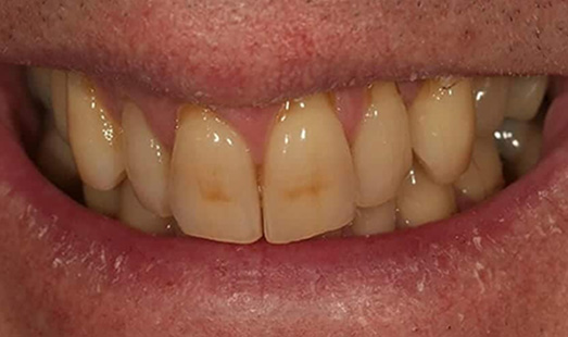mk dental excellence dentist cincinnati before teeth whitening
