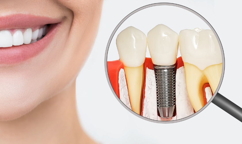 a comprehensive guide to dental implants in cincinnati - mk dental excellence