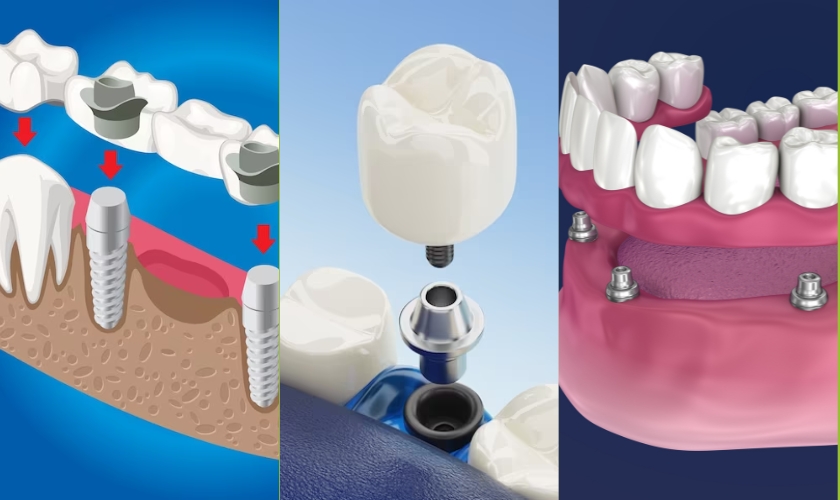learn about 3 types of dental implants with mk dental excellence cincinnati dentist