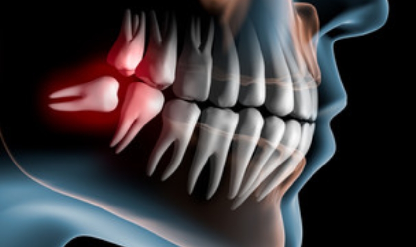 cincinnati dentist kejriwal answer can wisdom teeth grow back after extraction