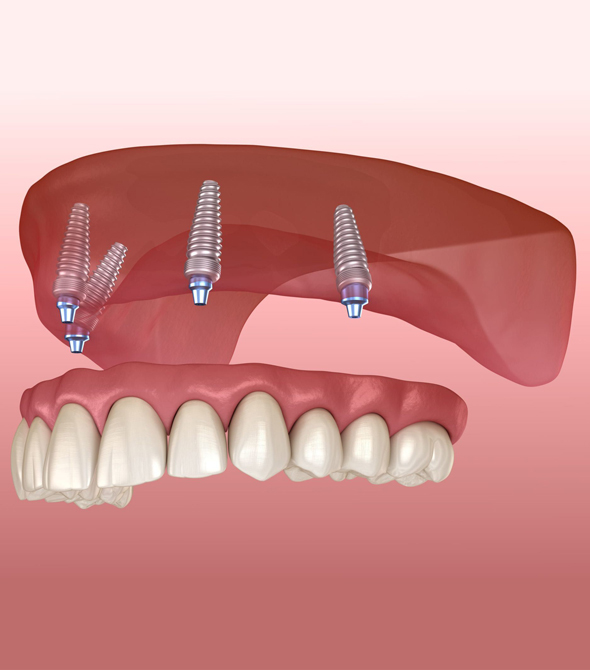 implant dentures in cincinnati at mk dental excellence dentist cincinnati