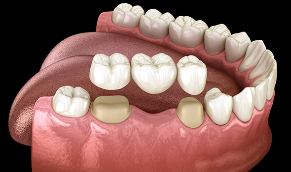 porcelain bridges in cincinnati at mk dental excellence dentist cincinnati