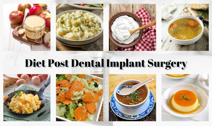 what can i eat after dental implant surgery