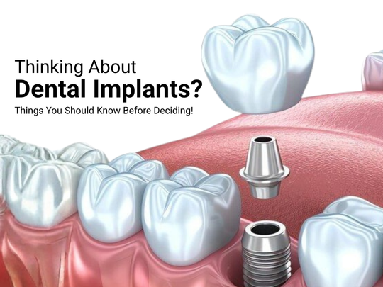 Thinking About Dental Implants in Cincinnati Read This Before You Decide