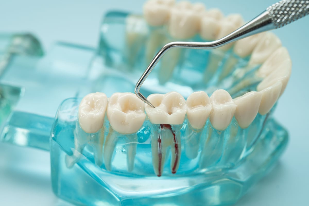 Root Canal Treatment in Cincinnati